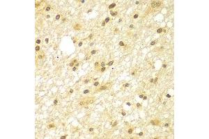 Immunohistochemistry of paraffin-embedded human brain cancer using TBL1XR1 antibody at dilution of 1:100 (x400 lens). (TBL1XR1 antibody)