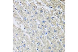 Immunohistochemistry of paraffin-embedded human liver cancer using MLKL antibody at dilution of 1:100 (40x lens). (MLKL antibody)