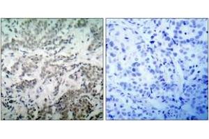 Immunohistochemistry analysis of paraffin-embedded human breast carcinoma tissue, using p53 (Ab-15) Antibody. (p53 anticorps  (AA 6-55))