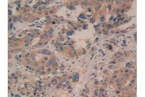 IHC-P analysis of Human Breast Cancer Tissue, with DAB staining. (BAD antibody  (AA 1-168))