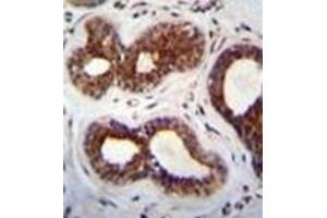 Immunohistochemistry analysis in formalin fixed and paraffin embedded human breast tissue recated with KIAA1586 Antibody (N-term) followed by peroxidase conjugation of the secondary antibody and DAB staining. (KIAA1586 antibody  (N-Term))