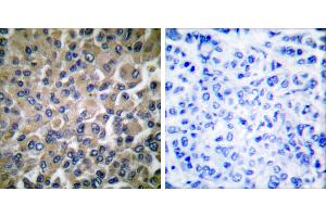 Peptide - +Immunohistochemical analysis of paraffin-embedded human breast carcinoma tissue using GRP78 antibody (#C0217). (GRP78 antibody)