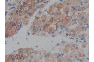 DAB staining on IHC-P; Samples: Human Stomach cancer Tissue (Prekallikrein antibody  (AA 156-364))