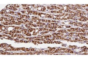 ABIN6272254 at 1/100 staining Human liver cancer tissue by IHC-P. (ADRB3 antibody  (Internal Region))