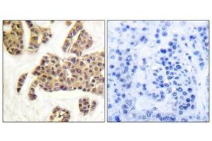Immunohistochemical analysis of paraffin-embedded human breast carcinoma tissue using BAD (Phospho-Ser91/128) antibody (left)or the same antibody preincubated with blocking peptide (right). (BAD antibody  (pSer91, pSer128))