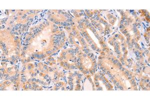 Immunohistochemistry of paraffin-embedded Human thyroid cancer tissue using CD109 Polyclonal Antibody at dilution 1:30 (CD109 antibody)