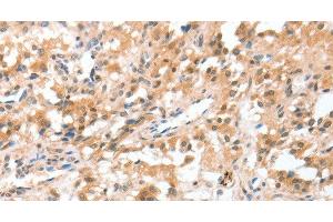 Immunohistochemistry of paraffin-embedded Human thyroid cancer using CIDEC Polyclonal Antibody at dilution of 1:50 (CIDEC antibody)