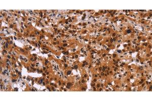 Immunohistochemistry of paraffin-embedded Human thyroid cancer using GPR124 Polyclonal Antibody at dilution of 1:40 (GPR124 antibody)