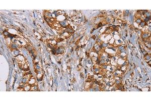 Immunohistochemistry of paraffin-embedded Human breast cancer using NDUFS1 Polyclonal Antibody at dilution of 1:50 (NDUFS1 antibody)