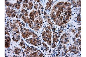 Immunohistochemical staining of paraffin-embedded Carcinoma of liver tissue using anti-HSD17B10mouse monoclonal antibody. (HSD17B10 antibody)