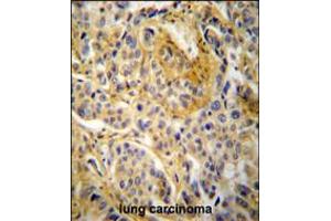 NCF1 Antibody immunohistochemistry analysis in formalin fixed and paraffin embedded human lung carcinoma followed by peroxidase conjugation of the secondary antibody and DAB staining. (NCF1 antibody  (N-Term))