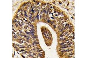 IHC analysis of FFPE human prostate carcinoma tissue stained with anti-HER2 antibody (ErbB2/Her2 antibody  (AA 1227-1255))