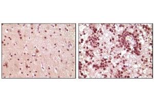 Immunohistochemical analysis of paraffin-embedded human brain tumor tissue, showing nuclear and cytoplasmic localization using ELK1 antibody with DAB staining. (ELK1 antibody)