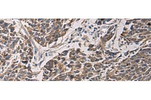 Immunohistochemistry of paraffin-embedded Human colorectal cancer tissue using MAPKAPK3 Polyclonal Antibody at dilution of 1:95(x200) (MAPKAP Kinase 3 antibody)