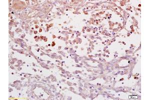 Formalin-fixed and paraffin embedded human endometrial carcinoma labeled with Anti IL-6R alpha/IL-6 receptor ? (IL6RA antibody  (AA 351-460))