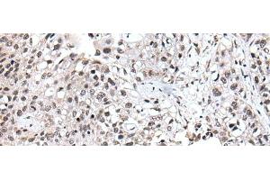 Immunohistochemistry of paraffin-embedded Human lung cancer tissue using UBE2E3 Polyclonal Antibody at dilution of 1:40(x200) (UBE2E3 antibody)