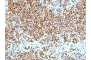 Formalin-fixed, paraffin-embedded human Lymphoma stained with CD45 Monoclonal Antibody (SPM569+SPM570). (CD45 antibody  (FITC))
