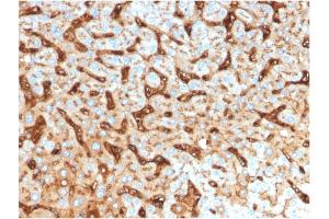 Formalin-fixed, paraffin-embedded human Hepatocellular Carcinoma stained with Albumin Mouse Monoclonal Antibody (ALB/2144). (Albumin antibody)