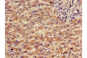 Immunohistochemistry of paraffin-embedded human liver cancer using ABIN7167854 at dilution of 1:100 (RBP4 antibody  (AA 19-201) (Biotin))