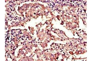 Immunohistochemistry of paraffin-embedded human lung cancer using ABIN7157854 at dilution of 1:100 (Lamin B1 antibody  (AA 385-552))