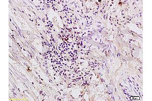 Formalin-fixed and paraffin embedded human colon carcinoma labeled with Anti-PAR-1 Polyclonal Antibody (ABIN728743), Unconjugated at 1:200, followed by conjugation to the secondary antibody and DAB staining (PAR1 antibody  (AA 251-350))