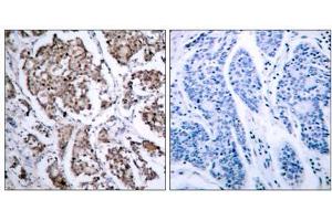 Immunohistochemical analysis of paraffin-embedded human breast carcinoma tissue using BAD (phospho- Ser155) antibody (E011069). (BAD antibody  (pSer155))