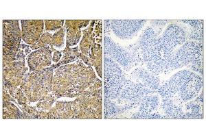 Immunohistochemistry analysis of paraffin-embedded human liver carcinoma tissue, using CYP8B1 antibody. (CYP8B1 antibody  (Internal Region))