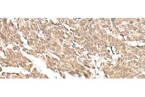 Immunohistochemistry of paraffin-embedded Human lung cancer tissue using KDM2A Polyclonal Antibody at dilution of 1:55(x200) (KDM2A antibody)