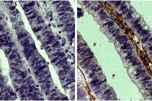 Paraffin embedded human gastric cancer tissue was stained with Goat IgG-UNLB isotype control, DAB, and hematoxylin. (Goat IgG isotype control (Biotin))