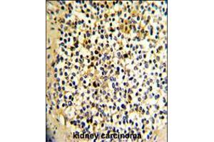 Formalin-fixed and paraffin-embedded human kidney carcinoma with DCXR Antibody , which was peroxidase-conjugated to the secondary antibody, followed by DAB staining. (Doublecortin antibody  (AA 79-106))