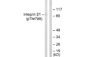 Immunohistochemistry analysis of paraffin-embedded human breast carcinoma tissue using Integrin β1 (Phospho-Thr788) antibody. (ITGB1 antibody  (pThr788))