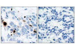 Immunohistochemical analysis of paraffin-embedded human breast carcinoma tissue using Histone H3. (Histone H3.1 antibody  (pSer10))