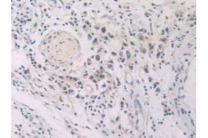 IHC-P analysis of Human Stomach Cancer Tissue, with DAB staining. (GLA antibody  (AA 81-429))