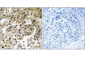 Immunohistochemistry analysis of paraffin-embedded human breast carcinoma, using HP1 alpha (Phospho-Ser92) Antibody. (CBX5 antibody  (pSer92))
