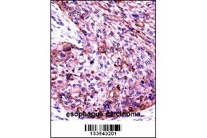 KRT6C Antibody immunohistochemistry analysis in formalin fixed and paraffin embedded human esophagus carcinoma followed by peroxidase conjugation of the secondary antibody and DAB staining. (Keratin 6C antibody  (N-Term))