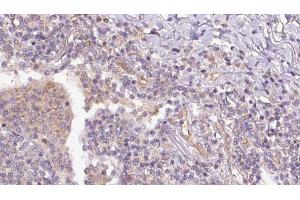 ABIN6273153 at 1/100 staining Human lymph cancer tissue by IHC-P. (RAP1B antibody  (C-Term))