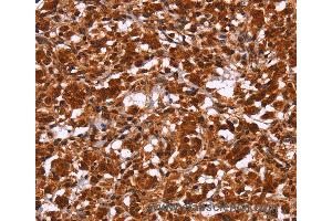 Immunohistochemistry of Human gastric cancer using HIPK1 Polyclonal Antibody at dilution of 1:30 (HIPK1 antibody)