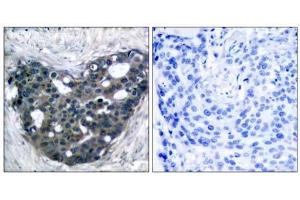 Immunohistochemical analysis of paraffin-embedded human breast carcinoma tissue using p56Dok-2 (Ab-299) antibody (E021270). (DOK2 antibody)