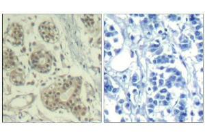 Immunohistochemical analysis of paraffin-embedded human breast carcinoma tissue using MDM2 (phospho-Ser166) Antibody (E011550). (MDM2 antibody  (pSer166))