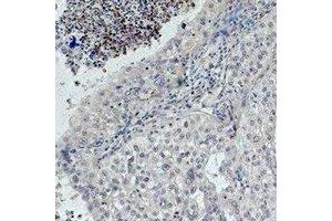 Immunohistochemical analysis of EGFR staining in human lung cancer formalin fixed paraffin embedded tissue section. (EGFR antibody)