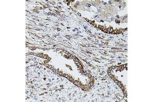 Immunohistochemistry of paraffin-embedded human lung cancer using SHH antibody (ABIN6291366) (40x lens). (Sonic Hedgehog antibody)