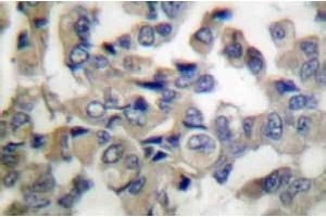 Immunohistochemistry Analysis: AP20201PU-N Synaptotagmin antibody staining of Paraffin-Embedded Human breast carcinoma tissue. (SYT1 antibody)