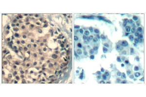 Immunohistochemical analysis of paraffin-embedded human breast carcinoma tissue using HDAC4/HDAC5/ HDAC9 (phospho-Ser246/259/220) Antibody (E011517). (HDAC4/HDAC5/HDAC9 antibody  (pSer220, pSer246, pSer259))
