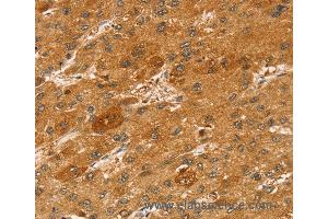 Immunohistochemistry of Human liver cancer using STX2 Polyclonal Antibody at dilution of 1:50 (STX2 antibody)