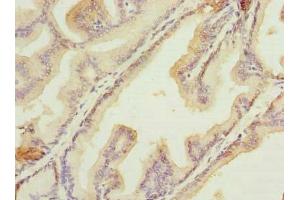 Immunohistochemistry of paraffin-embedded human prostate cancer using ABIN7156012 at dilution of 1:100 (HSDL2 antibody  (AA 1-345))