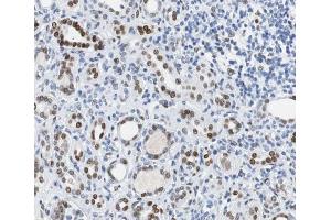 ABIN6267500 at 1/100 staining human Kidney carcinoma tissue sections by IHC-P. (BRCA1 antibody  (pSer1524))