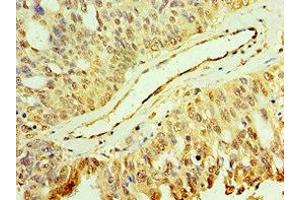 Immunohistochemistry of paraffin-embedded human endometrial cancer using ABIN7150705 at dilution of 1:100 (MAP2K3 antibody  (AA 1-170))