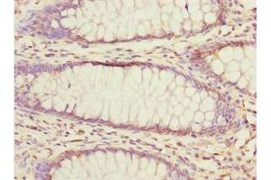 Immunohistochemistry of paraffin-embedded human colon cancer using ABIN7152363 at dilution of 1:100 (EYA3 antibody  (AA 1-300))