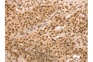 The image on the left is immunohistochemistry of paraffin-embedded Human breast cancer tissue using ABIN7131133(SNX8 Antibody) at dilution 1/25, on the right is treated with fusion protein. (SNX8 antibody)