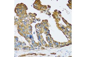 Immunohistochemistry of paraffin-embedded human colon carcinoma using SLC25A13 antibody. (slc25a13 antibody)